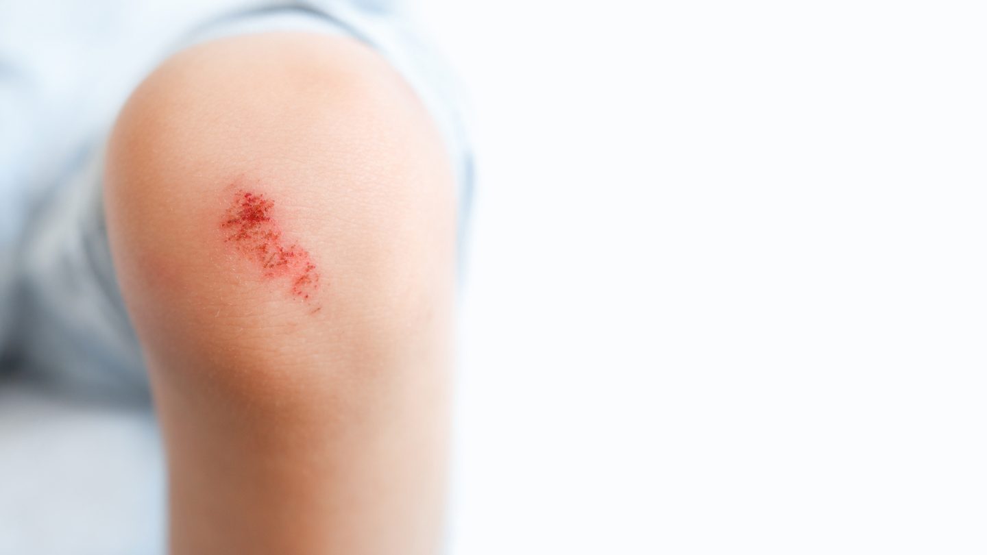 Luka lecet pada lutut