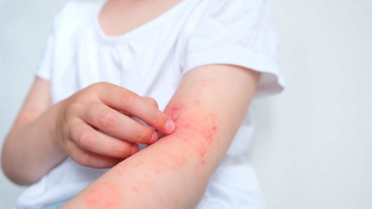 Kulit penderita Eksim dan cara mencegahnya