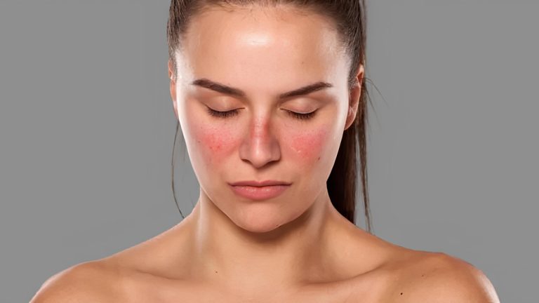 Bintik-bintik penuaan kemerahan pada wajah akibat lupus autoimmune (SLE)