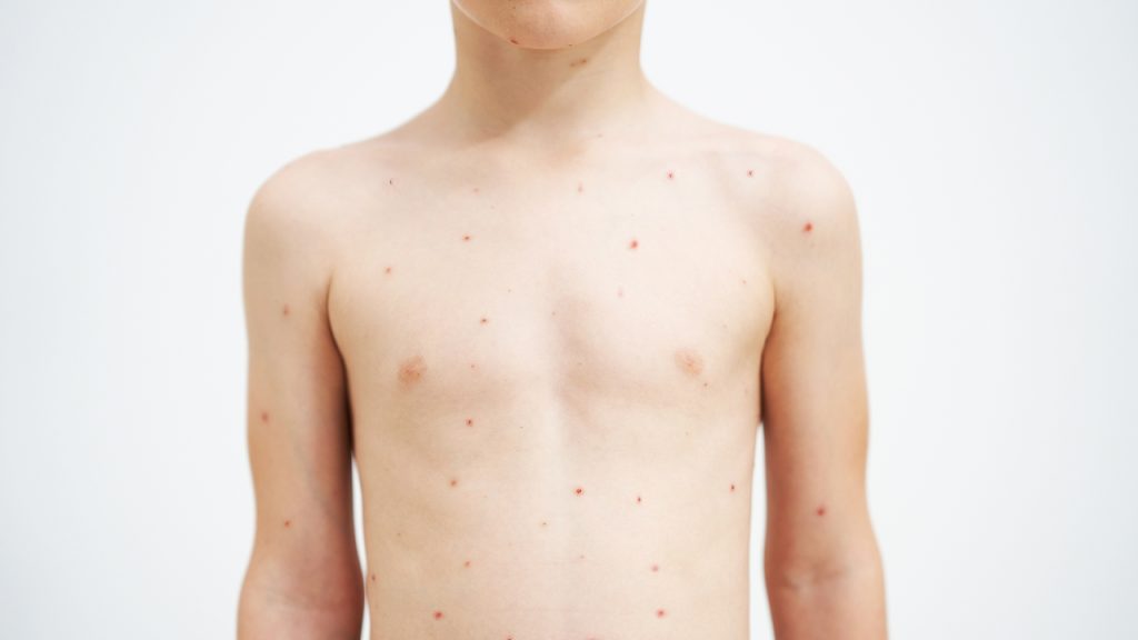 Badan anak kecil yang muncul titik titik merah.