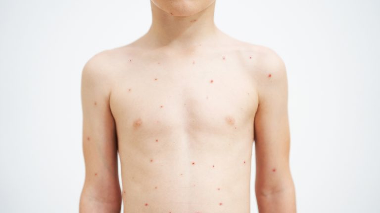 Badan anak kecil yang muncul titik titik merah.