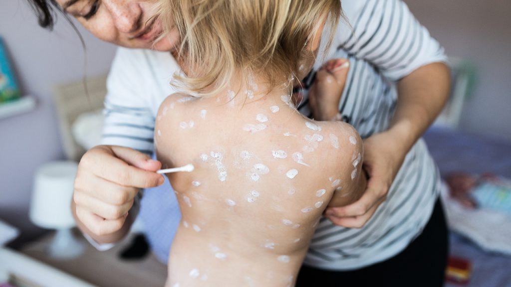 seorang anak penderita cacar air yang sedang diobati