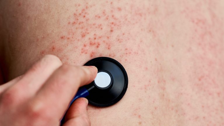 penyakit campak pada anak anak