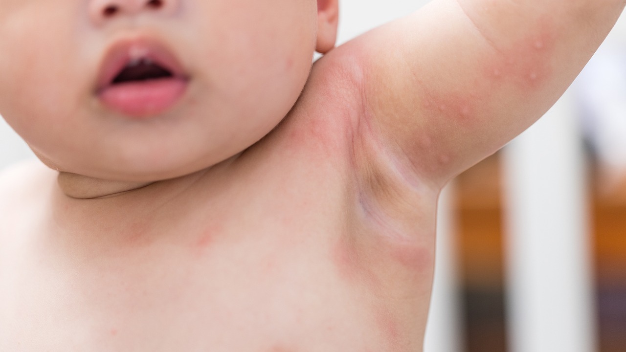 alergi dan iritasi kulit pada bayi